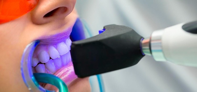 imagen de blanqueamiento dental con laser