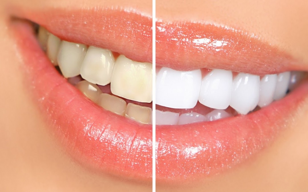 imagen de blanqueamiento dental
