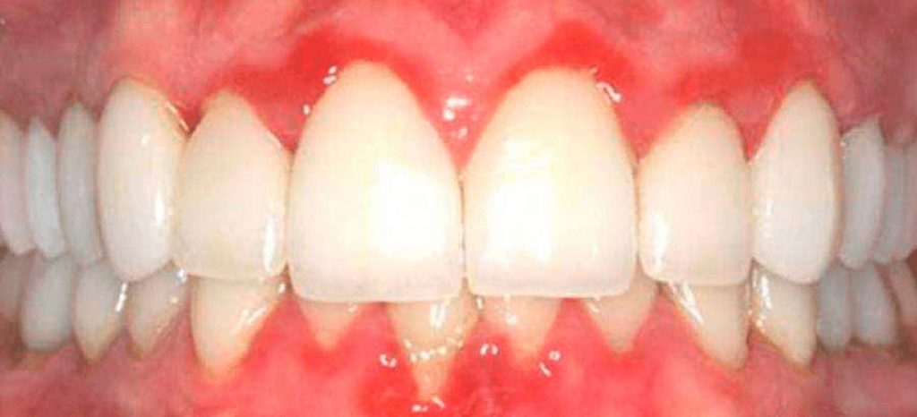 imagen de gingivitis
