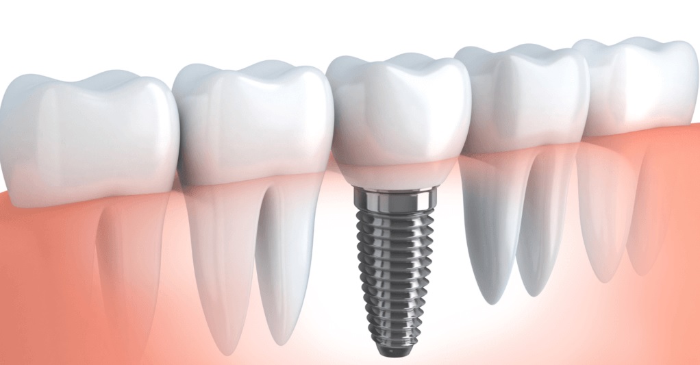 imagen de un implante dental
