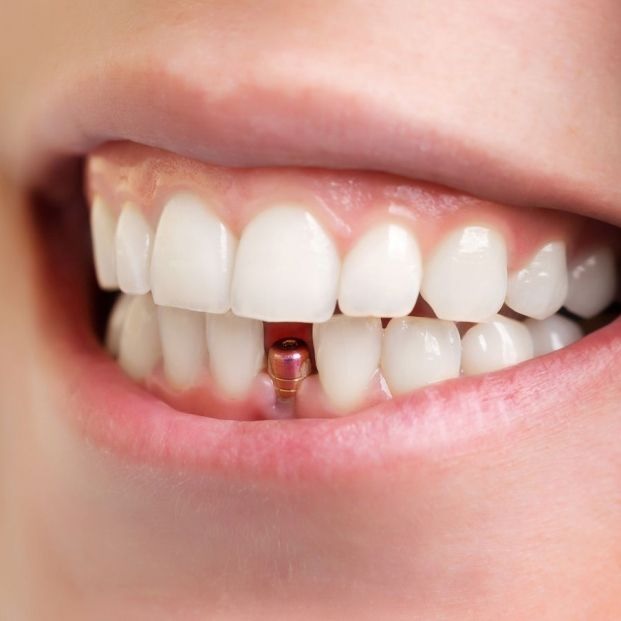 imagen de un implante dental