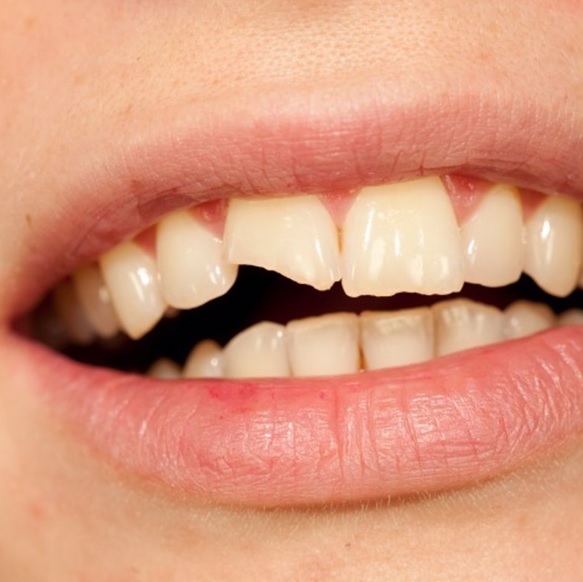 imagen de trauma dental