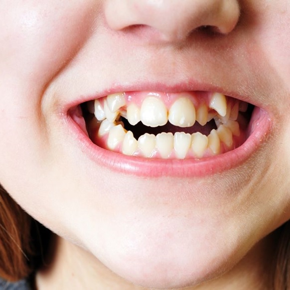 imagen de maloclusión oral